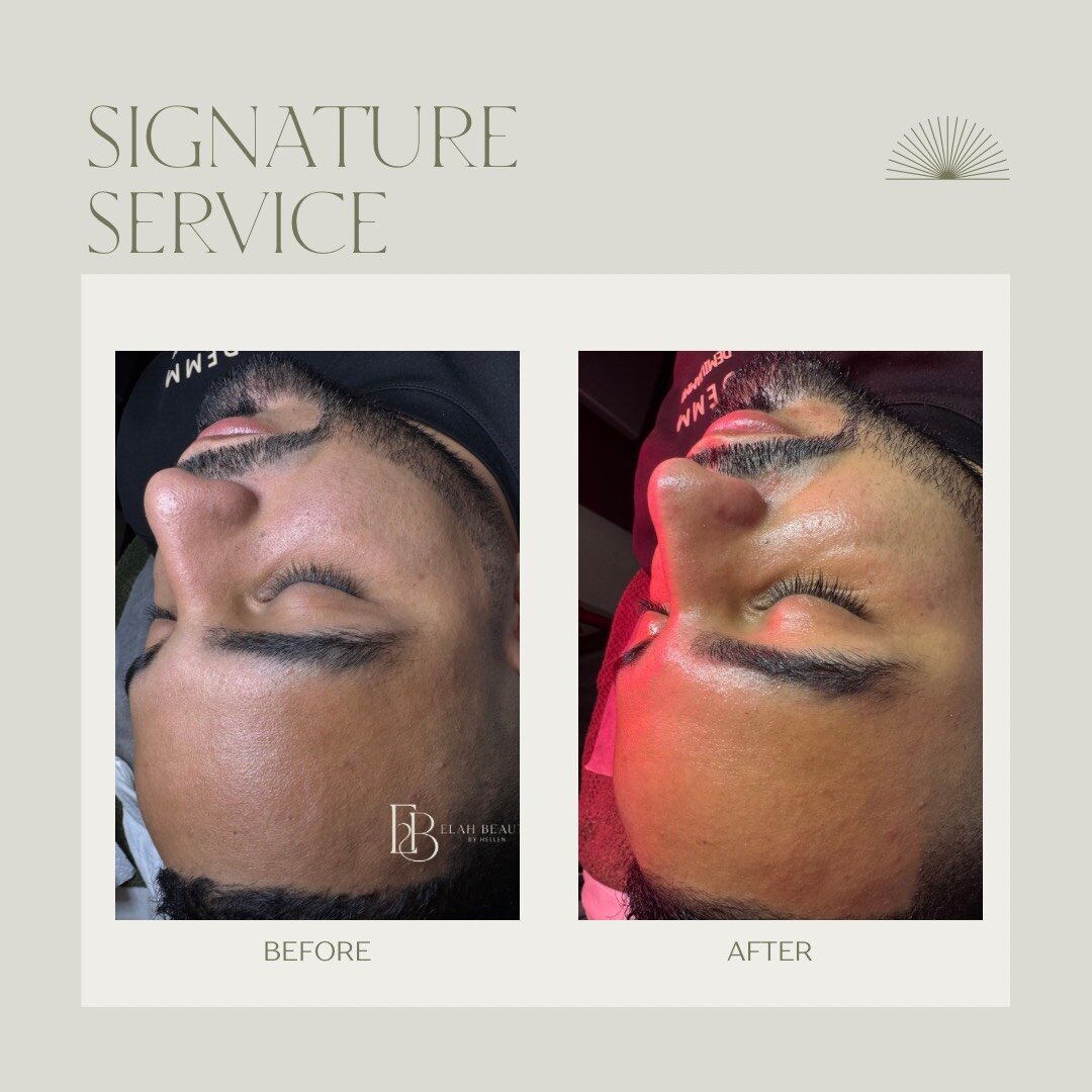 Before and After Treatment 5