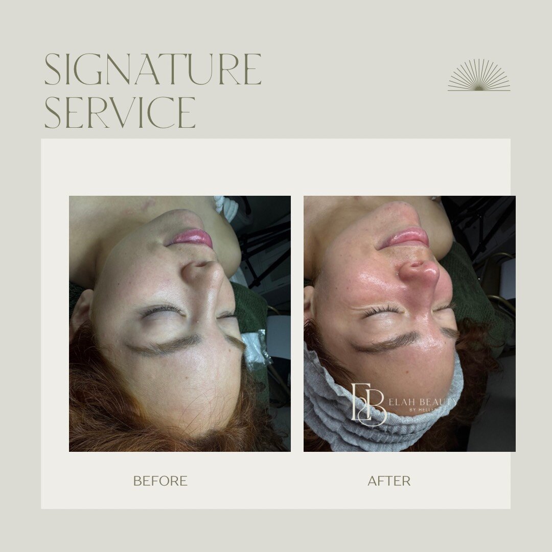 Before and After Treatment 1