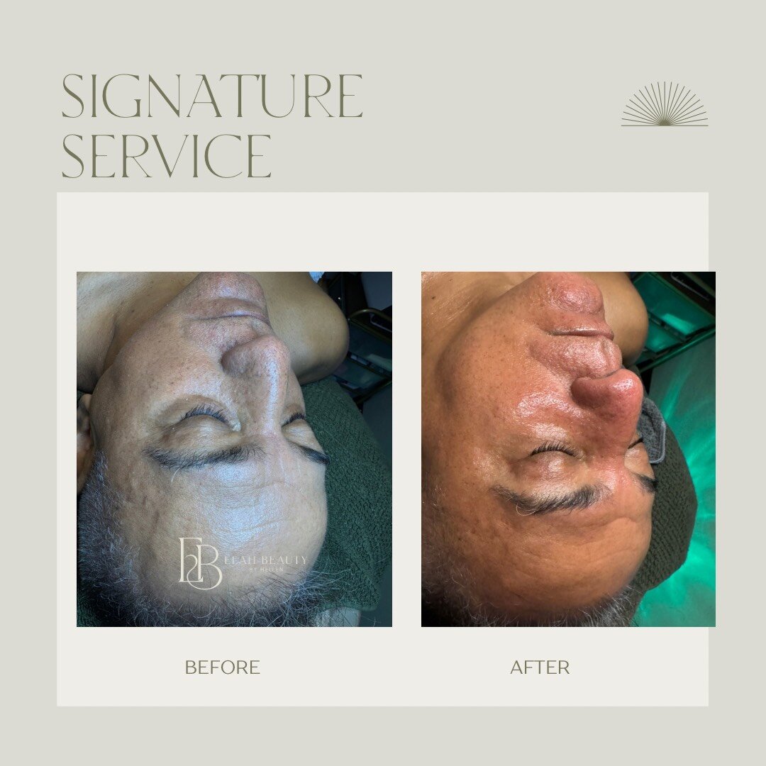 Before and After Treatment 2