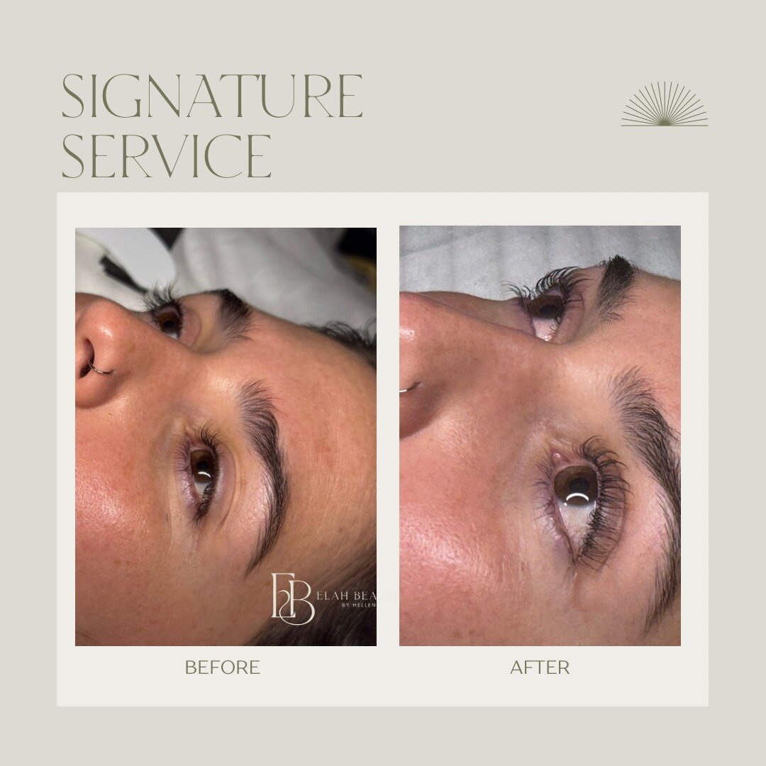 Before and After Treatment 3