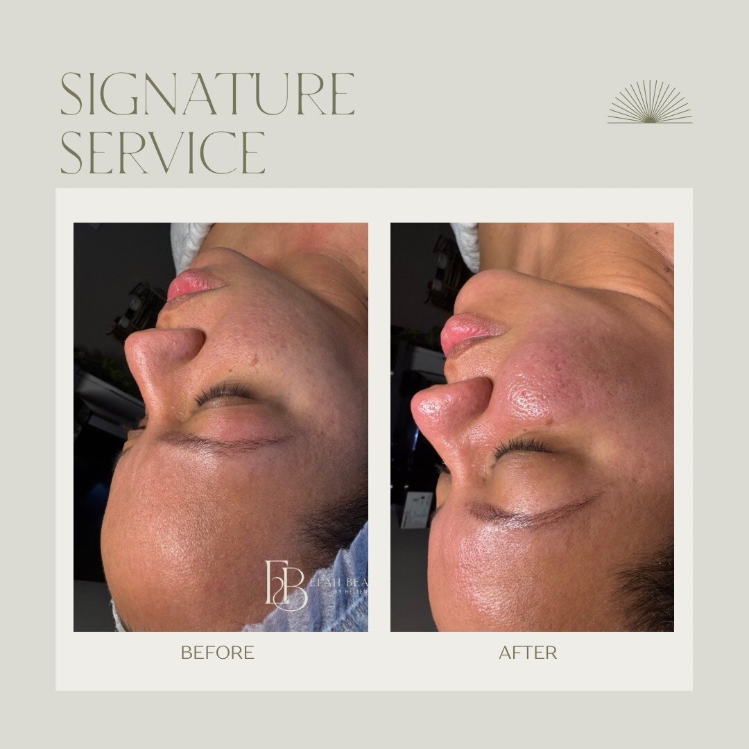 Before and After Treatment 4